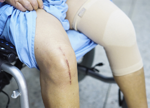 Knee Supports for Knee Replacement